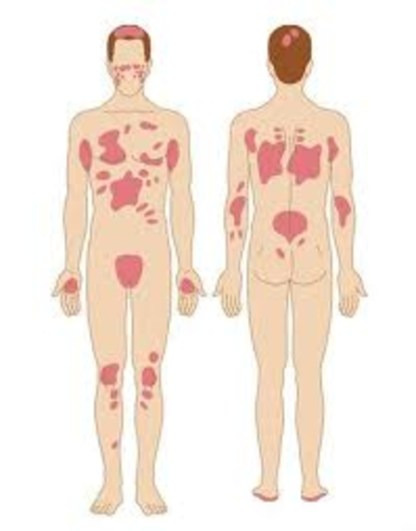 PSORIASI E VITILIGINE  :2